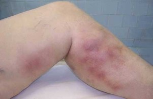 Thrombophlebitis with varicose veins in women