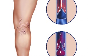 Complications of varicose veins
