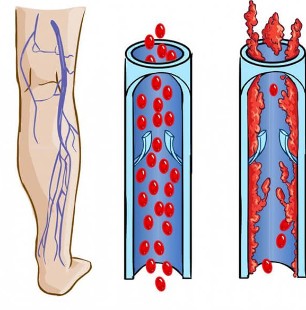 What does a normal vein and a vein look like with varicose veins