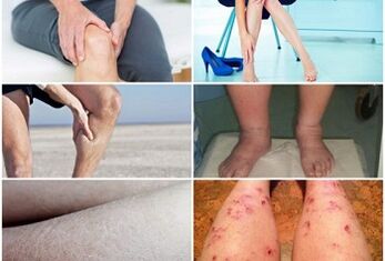 Symptoms of varicose veins on the legs