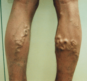 traditional methods of treating varicose veins