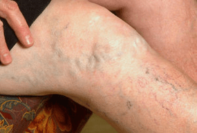 varicose veins on the legs