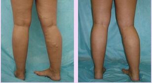 how does varicose veins of the first stage manifest