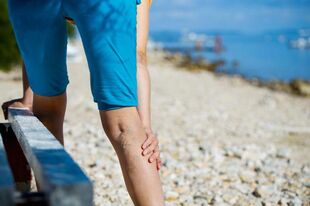 Varicose veins of the lower extremities from physical exertion