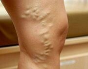 Varicose veins of the lower extremities during pregnancy
