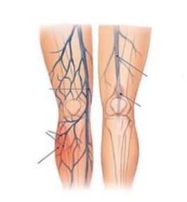venous thrombosis requires surgery