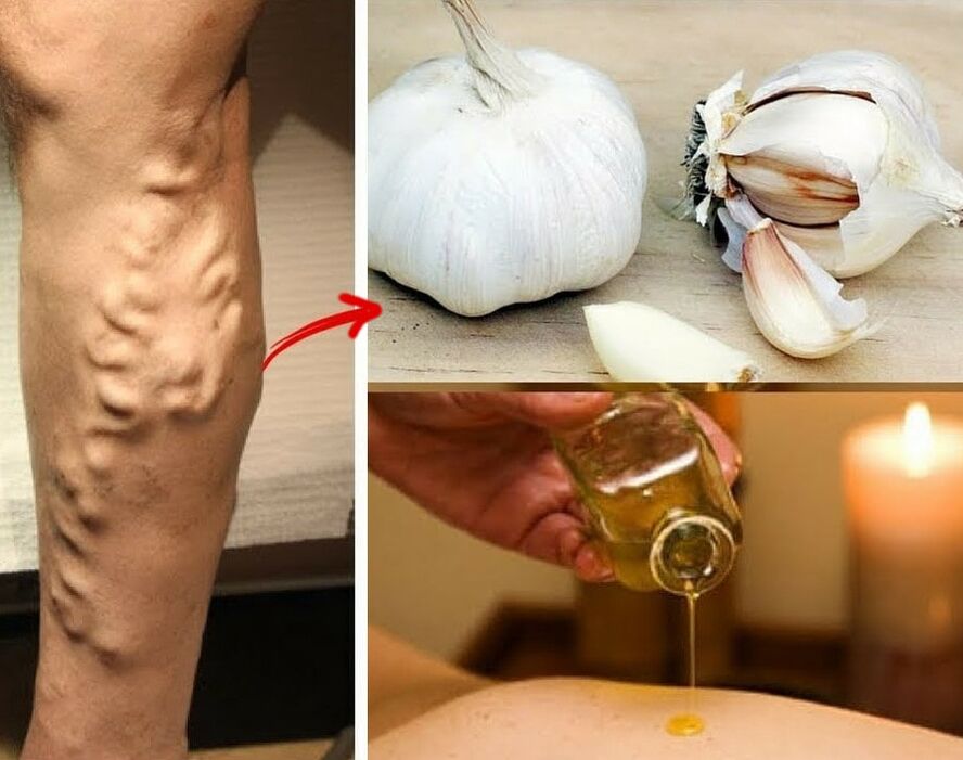 folk remedies for the treatment of varicose veins