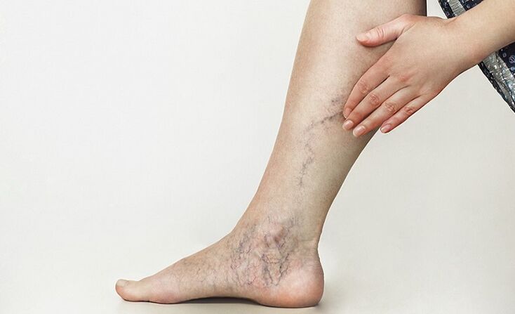 varicose veins and its treatment with folk remedies
