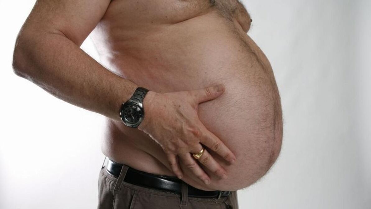 obesity as a cause of the development of varicose veins