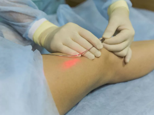 Treatment of varicose veins laser