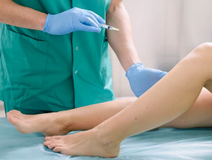 Treatment of varicose veins