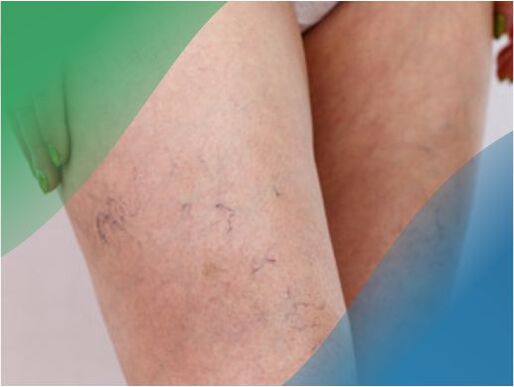The vascular network on the legs is one of the symptoms of varicose veins