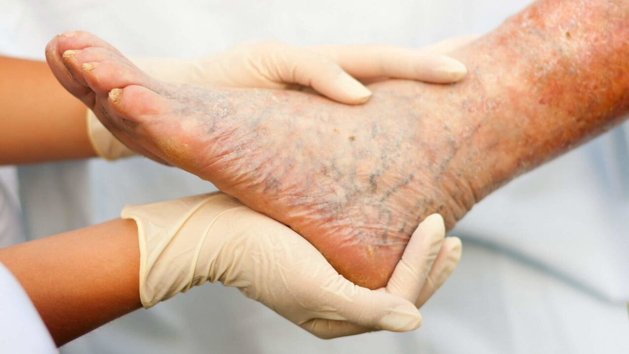 The phlebologist deals with the treatment of varicose veins in the legs