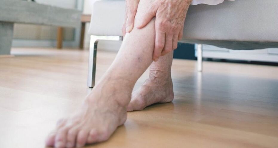 Varicose veins of the lower extremities caused by malfunction of the venous valve