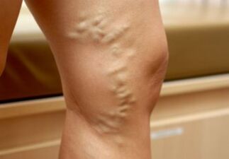 Varise veins on a woman's legs