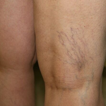 Venous mesh on the lower extremities is a sign of varicose veins