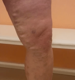 varicose veins