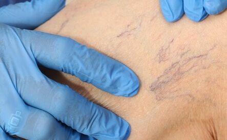Symptoms of varicose veins