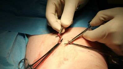 Flebectomy for varicose veins