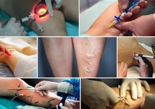 Modern methods of treatment of varicose veins