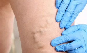 Treatment of varicose veins with the help of bioadhesive